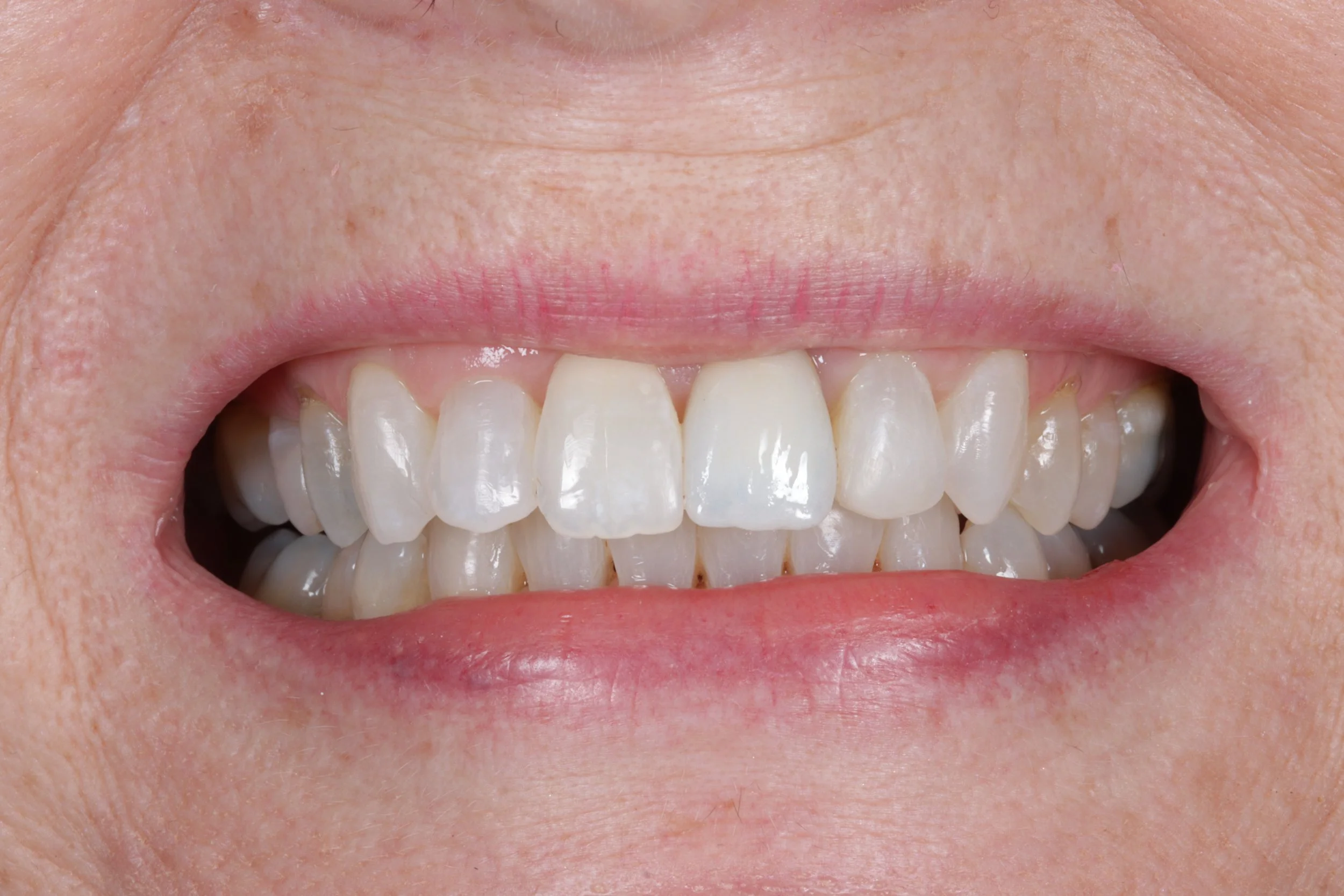 Crowded teeth after Invisalign in Essex