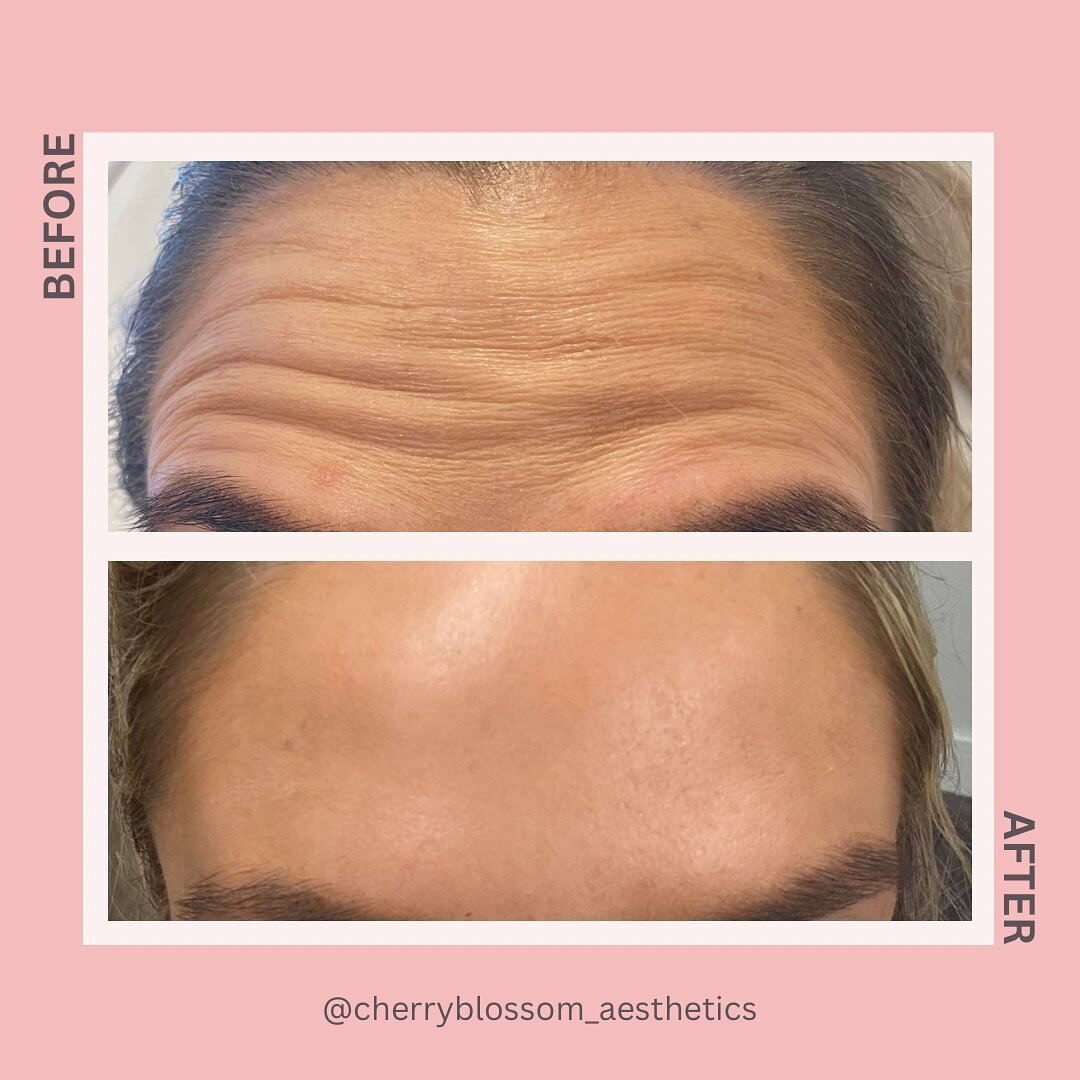 REAL RESULTS ✨: Before &amp; After pictures taken 2 weeks apart following anti wrinkle treatment.👌 

Book your appointment today. 🔗 in bio. 🌸
.
.
.
.
#cherryblossomeaesthetics #aesthetics #aesthetician #aestheticiancumbria #aestheticscumbria #micr