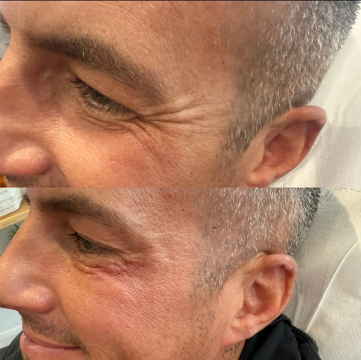 💫 Feel Good Friday 💫 

Look 👀 at this transformation in just one week! ✨ our fabulous client embraced self-care with a combination of Botox and polynucleotides, targeting those tiresome dark circles, crepey skin &amp; stubborn crows feet around th