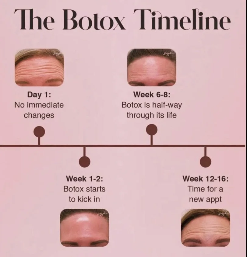 Botox Timings 🕰️ summary 😜 

🌟 Immediate Reaction: You might feel like a million bucks... or just a little frozen! 🤖

🌟 1-2 Days Post-Treatment: Expect to start looking less like a road map and more like a smooth highway. 🛣️

🌟 Week 1-2:Voil&a