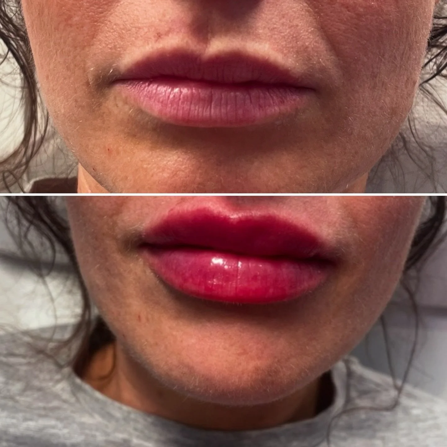 💫 Less can be more 

Showing the power of what 0.5ml can achieve with precise placement 💯
✨ hydrated
✨ softly full
✨ still YOU

Perfect for enhancing naturally well-shaped lips 👄 while keeping the result elegant and effortlesss