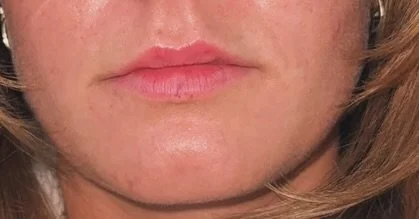 Soft, subtle, and natural ✨💋

This beauty had slight lip asymmetry, so we took a slow, gradual approach&mdash;building shape and balance over a few appointments rather than overfilling in one session.

The goal? Enhanced, even lips that still look l