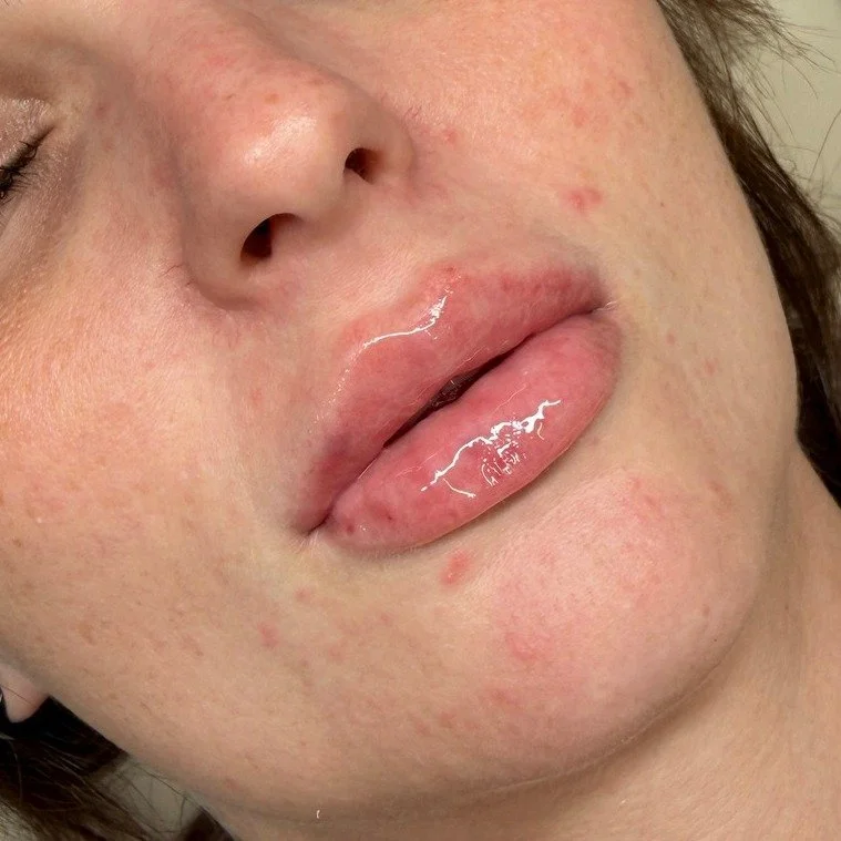 "I'd love to have my lips done, but I don't want everyone to KNOW I've had them done."

I hear this so often.

You might feel like your lips have lost a little fullness, wish your top lip was more defined or simply want a bit more balance.

