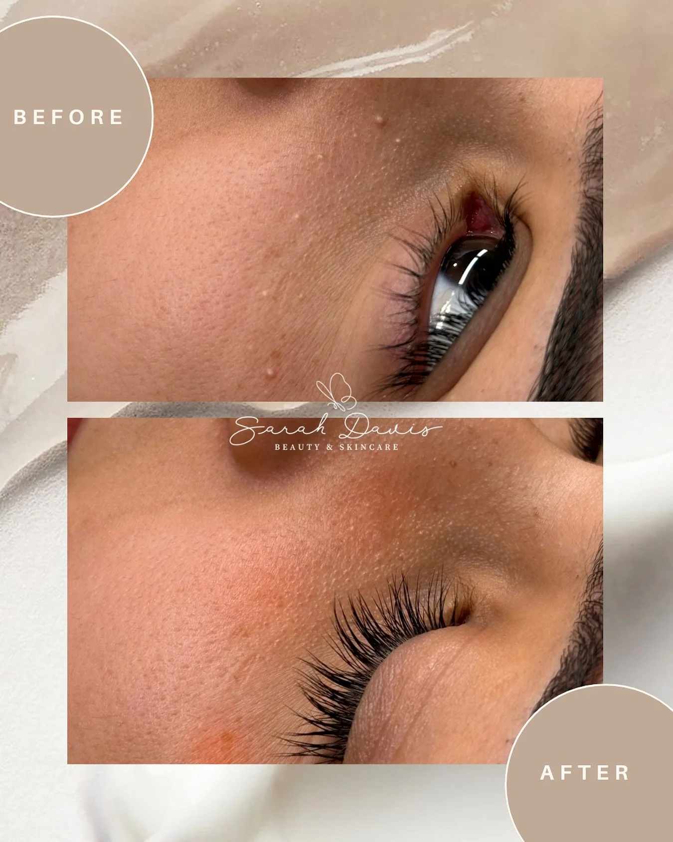 Milia extraction is the little secret to a silky, even complexion. Just one session can make all the difference 🤍