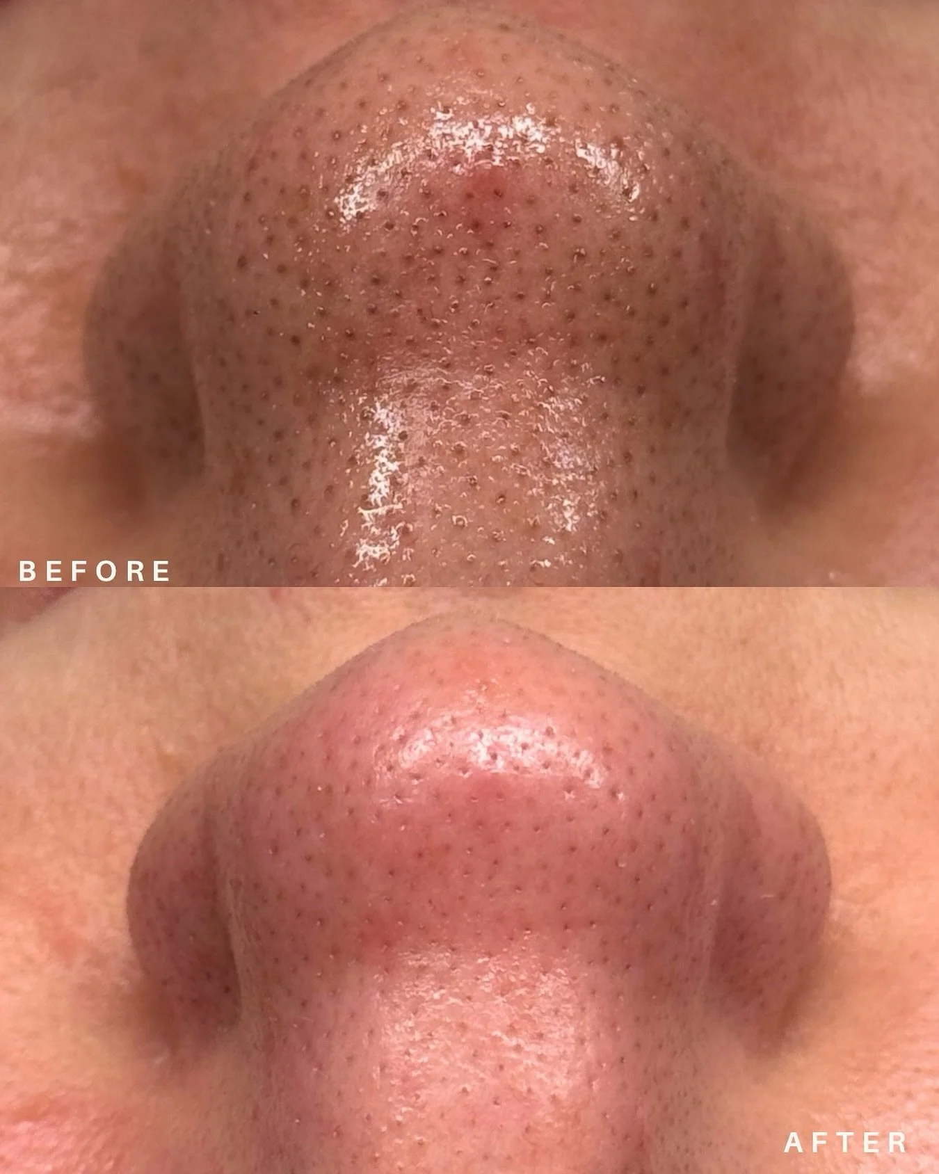 LOVE this before &amp; after on my client 🩷 this is about 5-6 min of extractions during our 1 hour long facial 🧚&zwj;♀️ 
.

.
.

#californiaesthetician #chemicalpeels #elcentro #elcentrobeauty #imperialvalleybeauty #imperialvalley #calexico #spalif