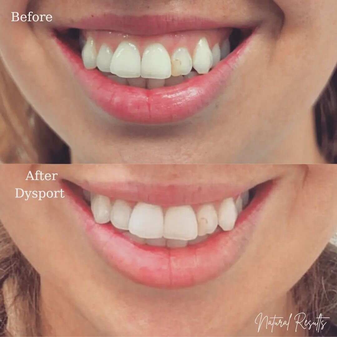 Gummy smile correction and lip flip using Dysport 💉 to create natural volume in lips and less gum show. 
 
Obsessed with these results and the confidence in this beautiful smile 🥰