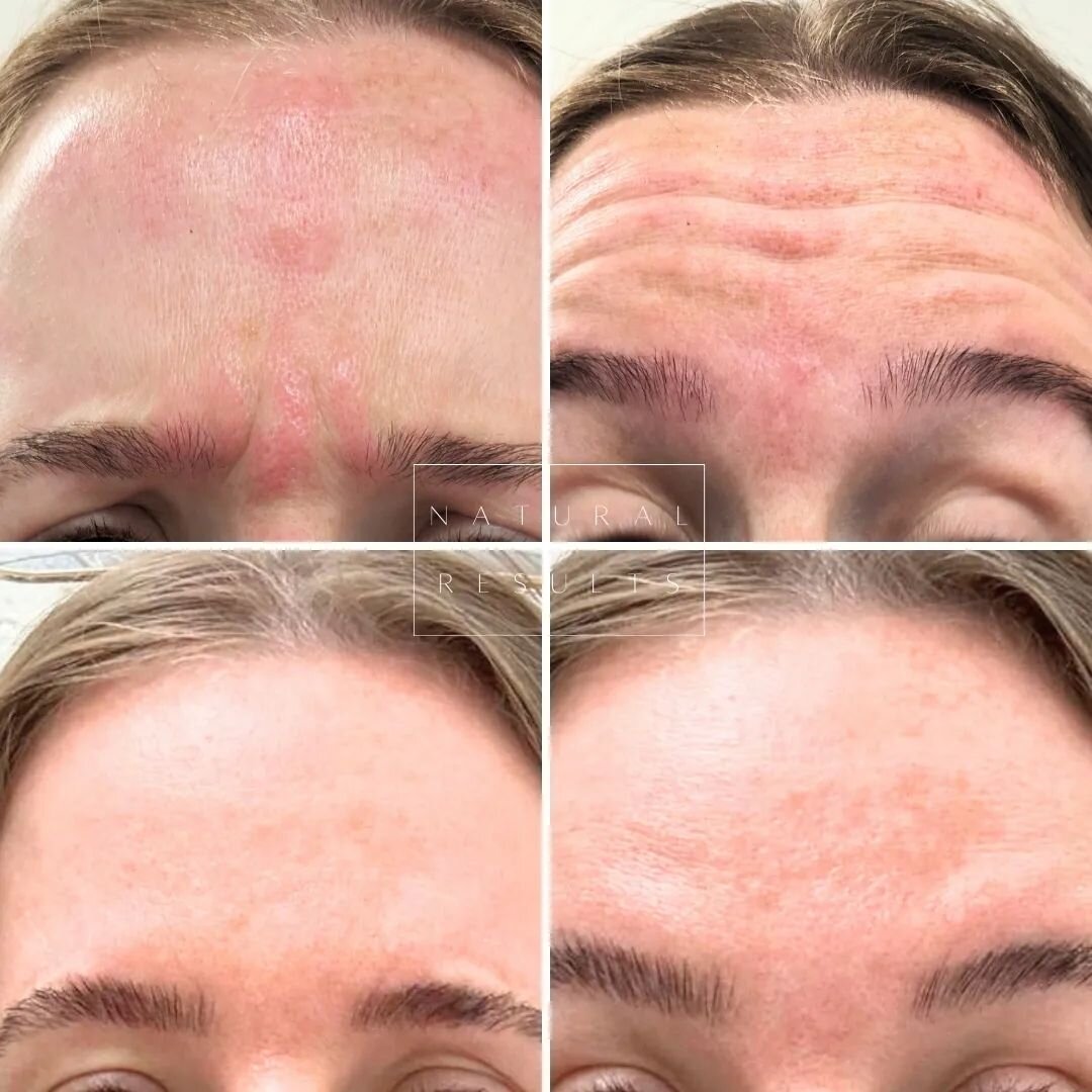 Want to wake up feeling refreshed?

Our best recommendation is to treat between your eyebrows and forehead to wake up looking refreshed and smooth.

Botox (and equivalents) treatments have the added benefit of reducing oil production and acne making 