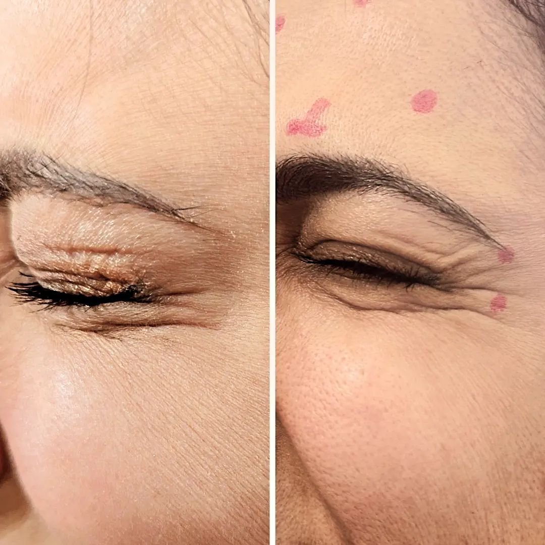 Crow's feet are fine wrinkles that fan out from the corners of your eyes. They're a natural part of aging, caused by repeated facial expressions like smiling, squinting, and even frowning. The delicate skin around the eyes is thinner and loses elasti