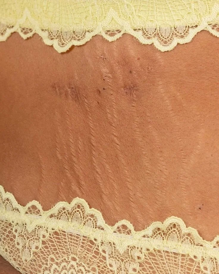 Vergetures et la peau moins ferme ? Prends ma routine