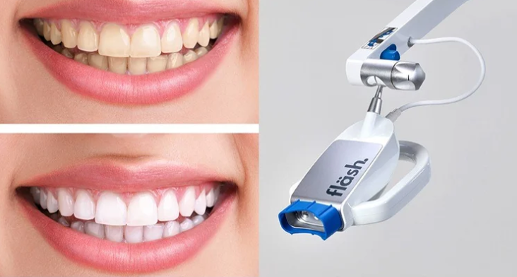 Bleaching (Zahnaufhellung)