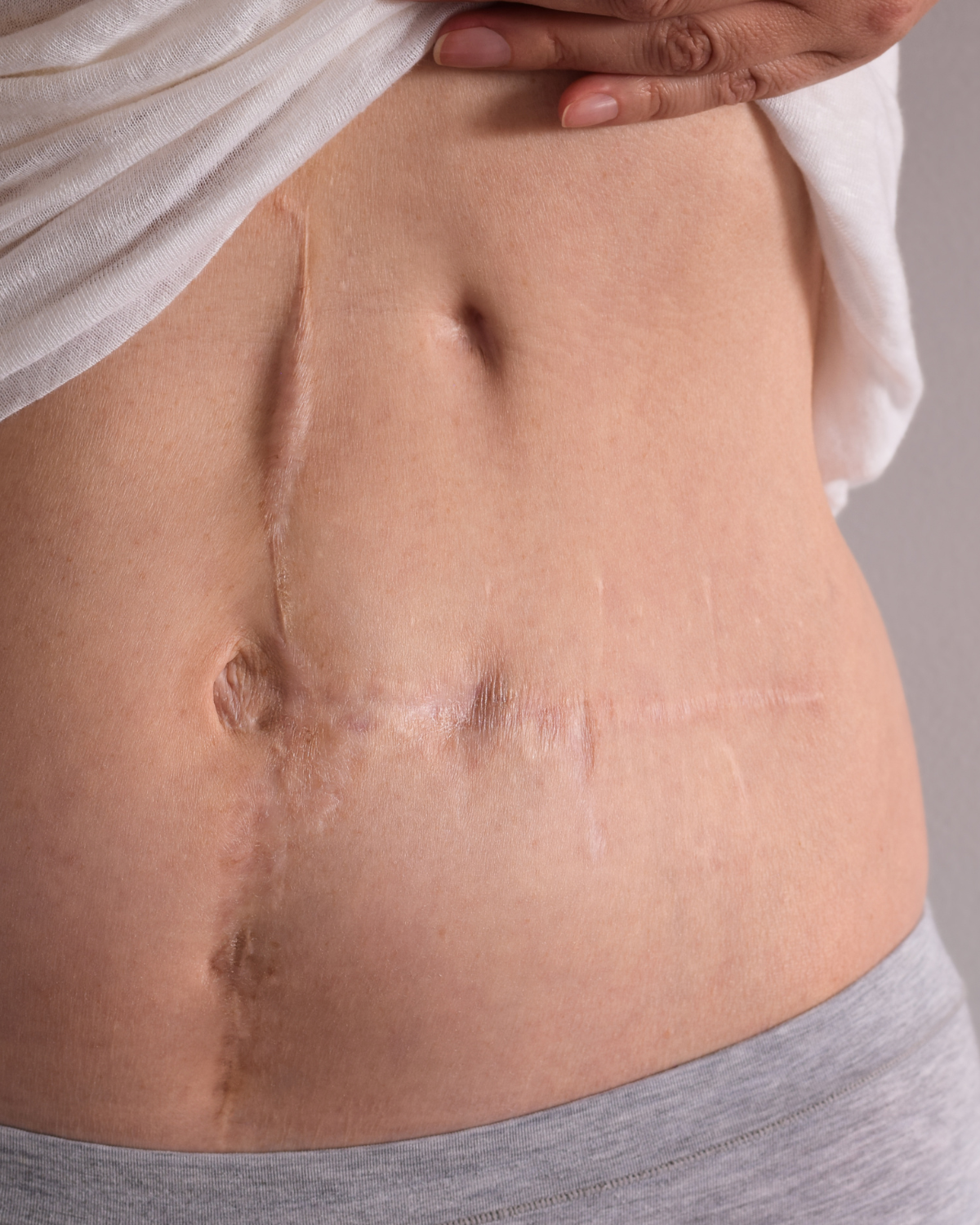 Why Scars Matter for Skin Health