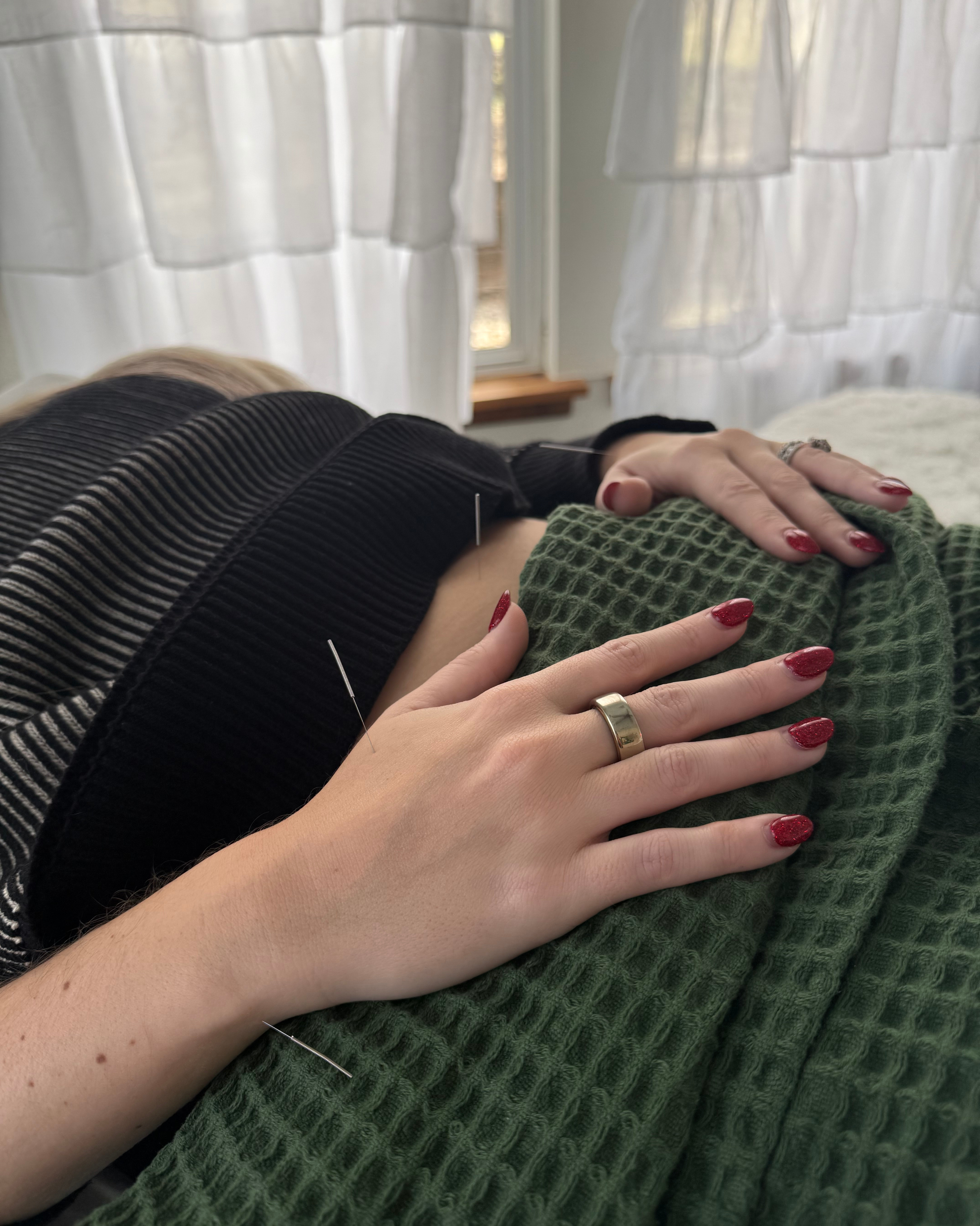 Chiropractic Acupuncture supporting nervous system regulation at The Chiropractic Place for Mommy and Me near Weatherford, Texas