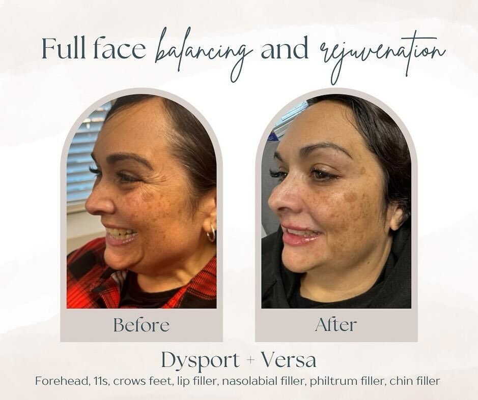 This transformation has us 😍😍😍 

Come visit our beautiful aesthetics lounge and check out what services we can offer you! We absolutely love seeing our clients happy and confident in their skin. 

Visit our website or give us a call for a consulta