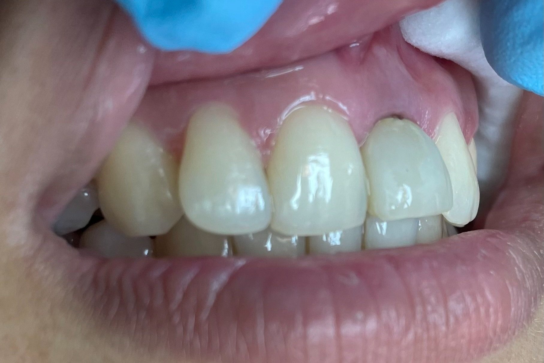 Dental Implant Photos