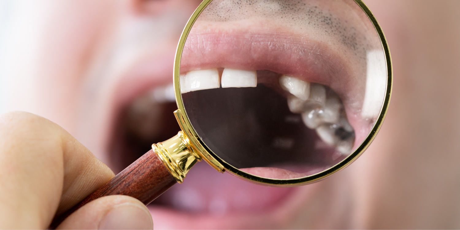 All-on-4 Dental Implants vs Traditional Implants