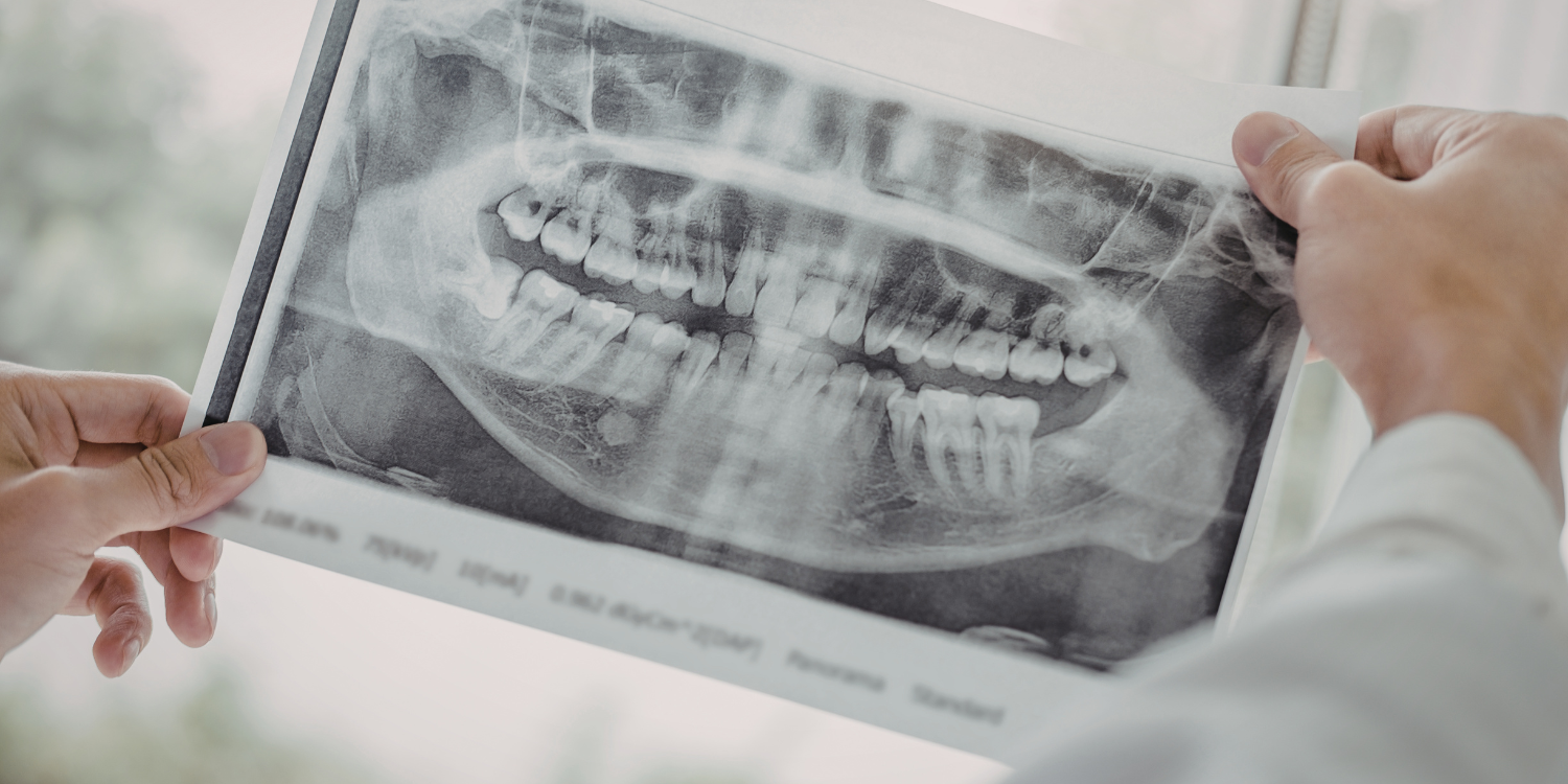 Do I Really Need Dental X-Rays Every Year?