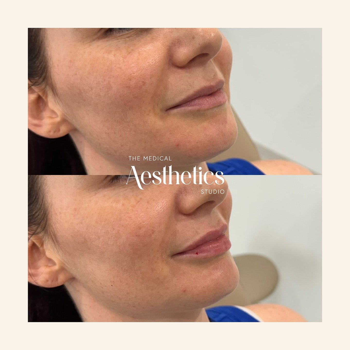Patient results.
Treatment options can be discussed during consultation with Dr Sally at The MAS #themedicalaestheticsstudio #brisbane #medicalaesthetics