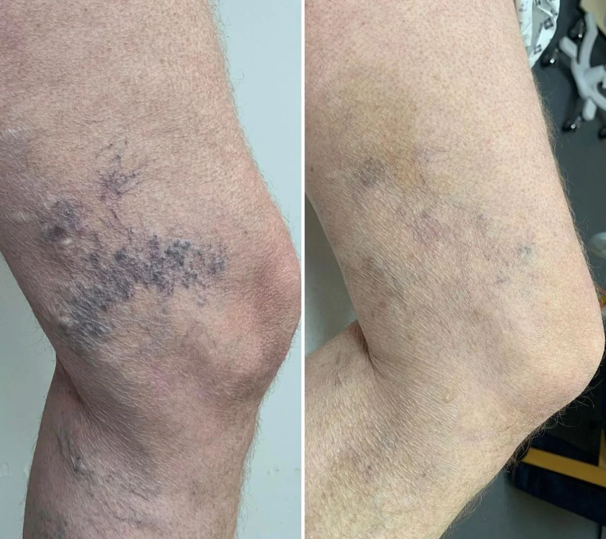 Results following sclerotherapy to thread veins
