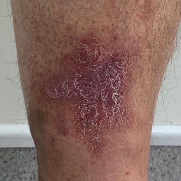 Varicose eczema - NHS