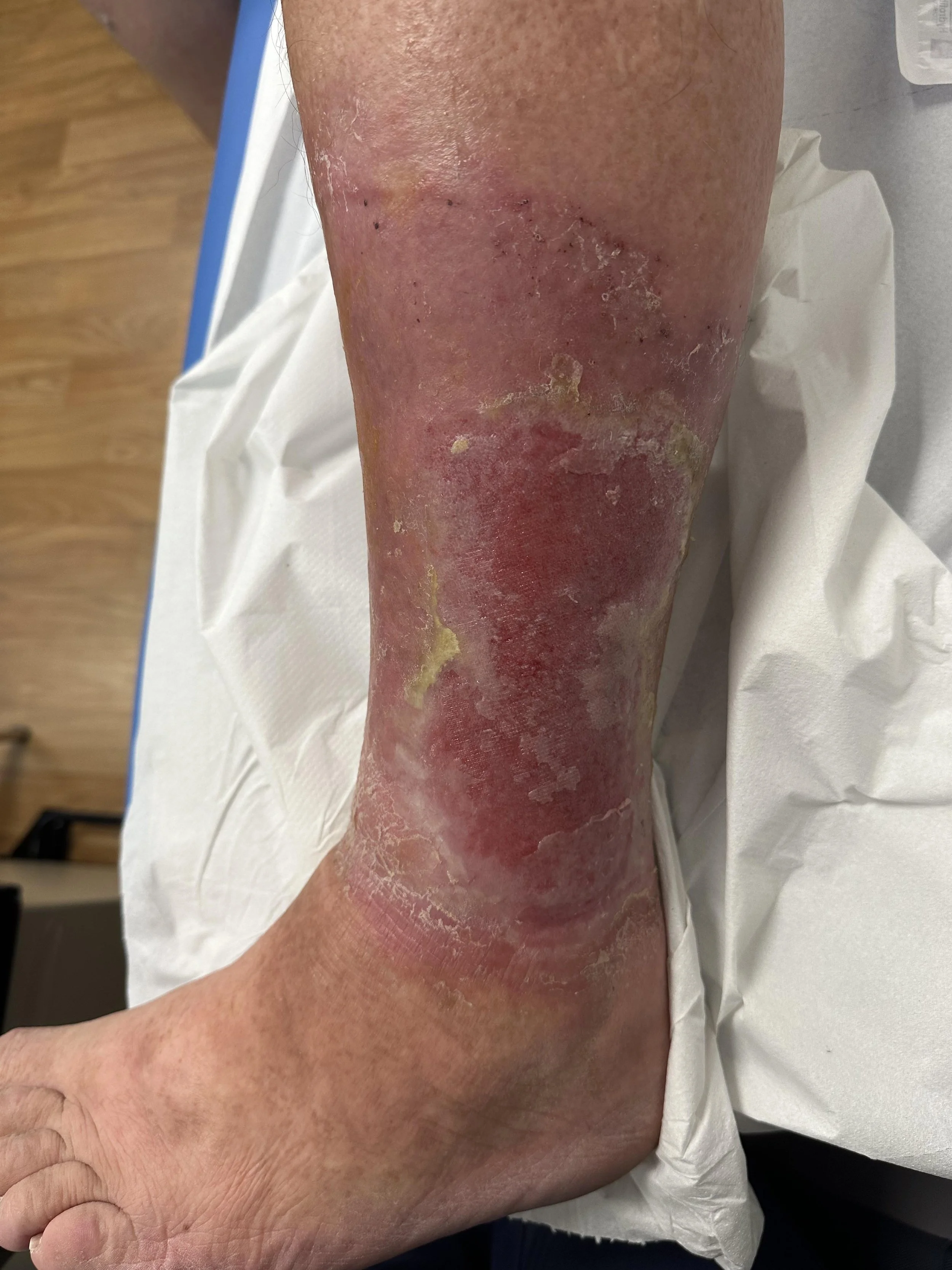 Superficial ulceration lower leg