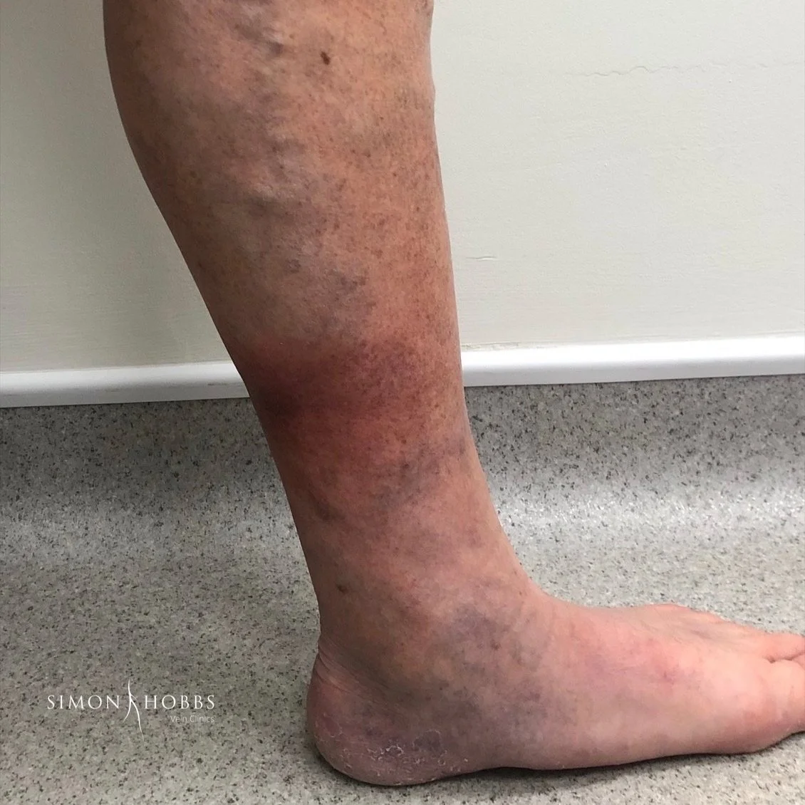 Leg showing varicose veins in the thigh