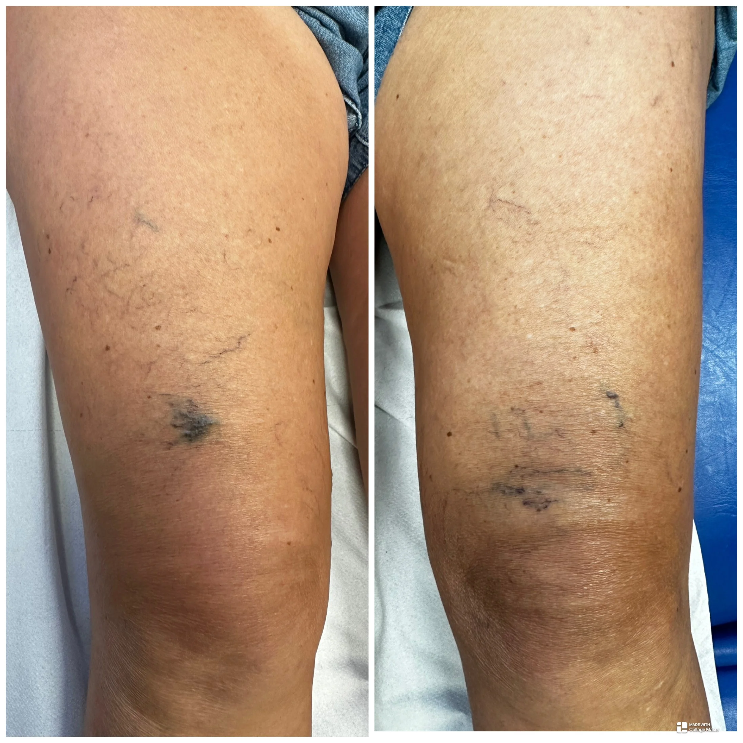 Thread veins around the knee