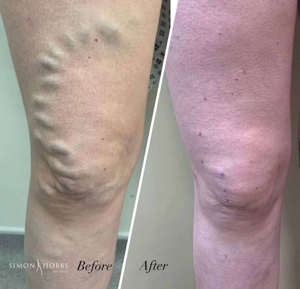 Before and after photos, large varicose veins in thigh, radiofrequency ablation