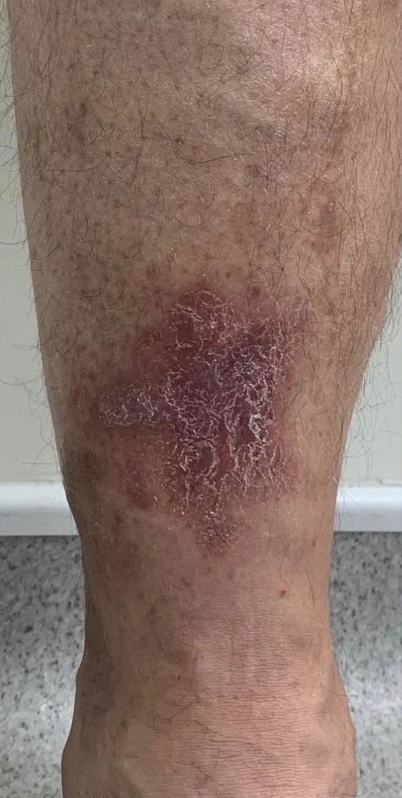 Varicose eczema on shin