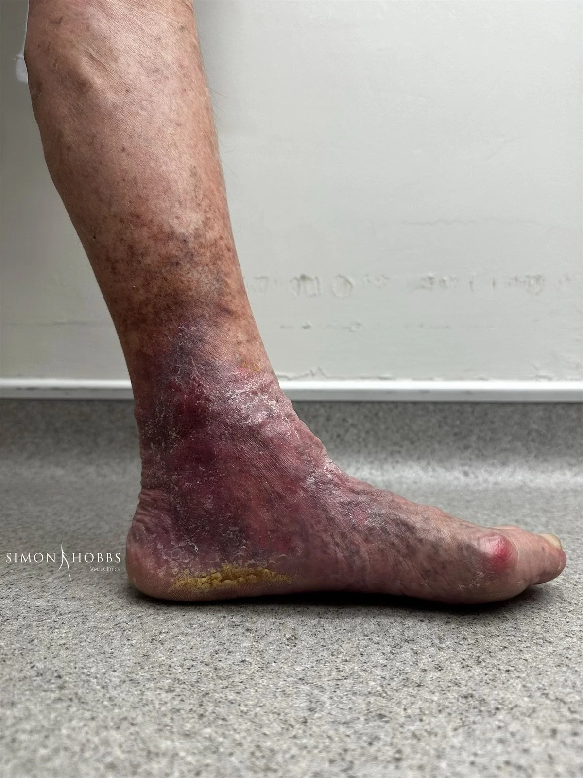 Venous eczema around ankle area due to calf varicose veins