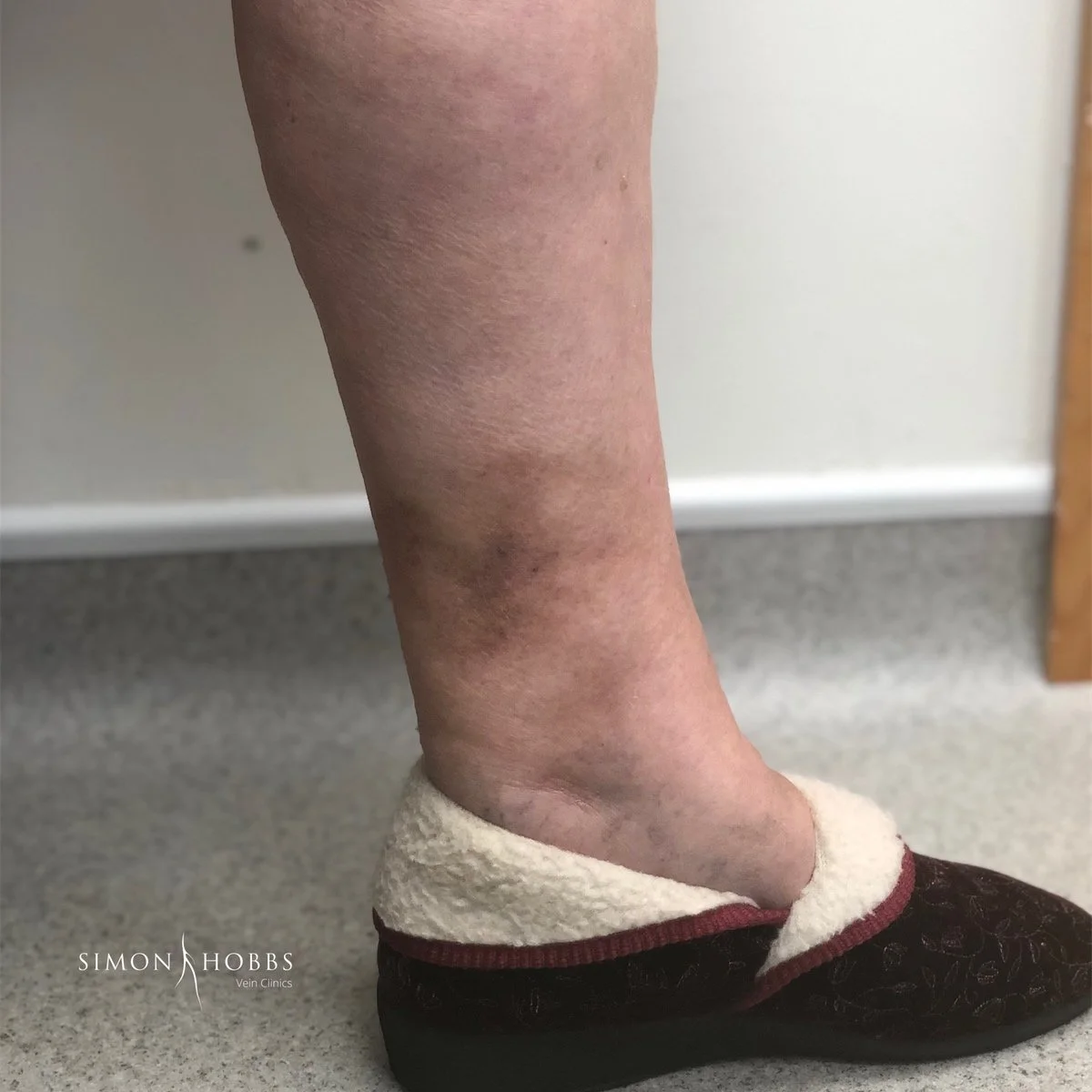 Phlebitis in vein inner calf, hard and red