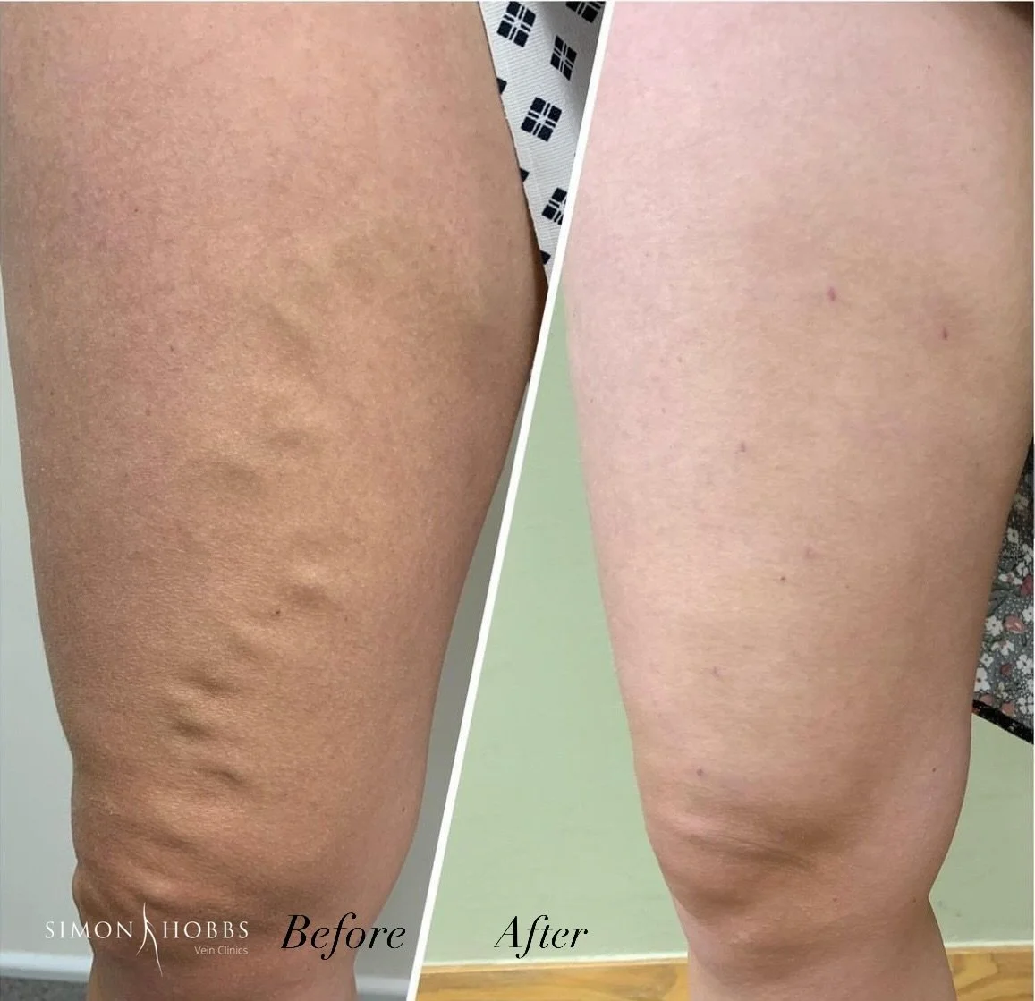Leg ulcer in patient with venous disease