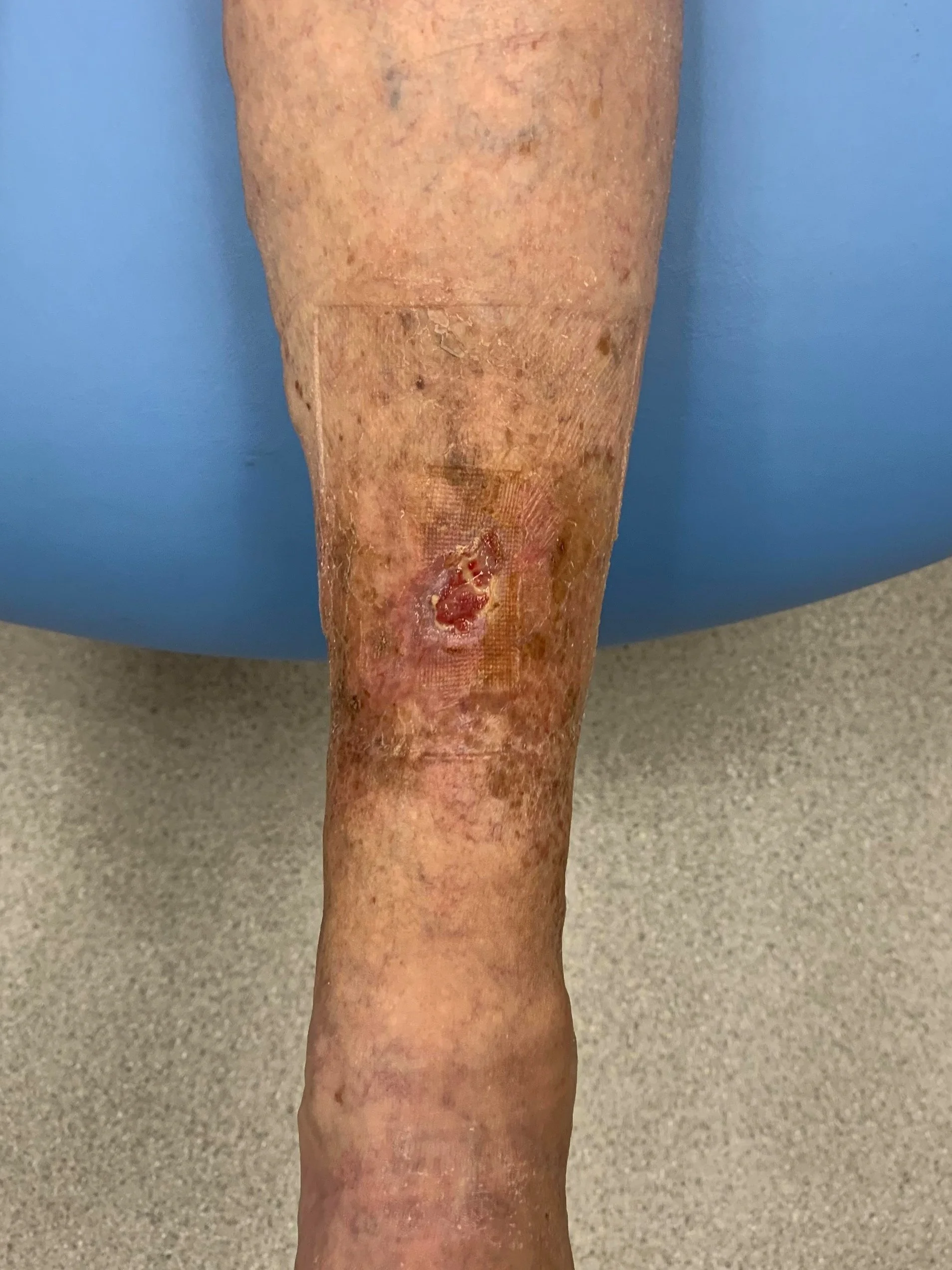 Leg ulcer in patient with venous disease
