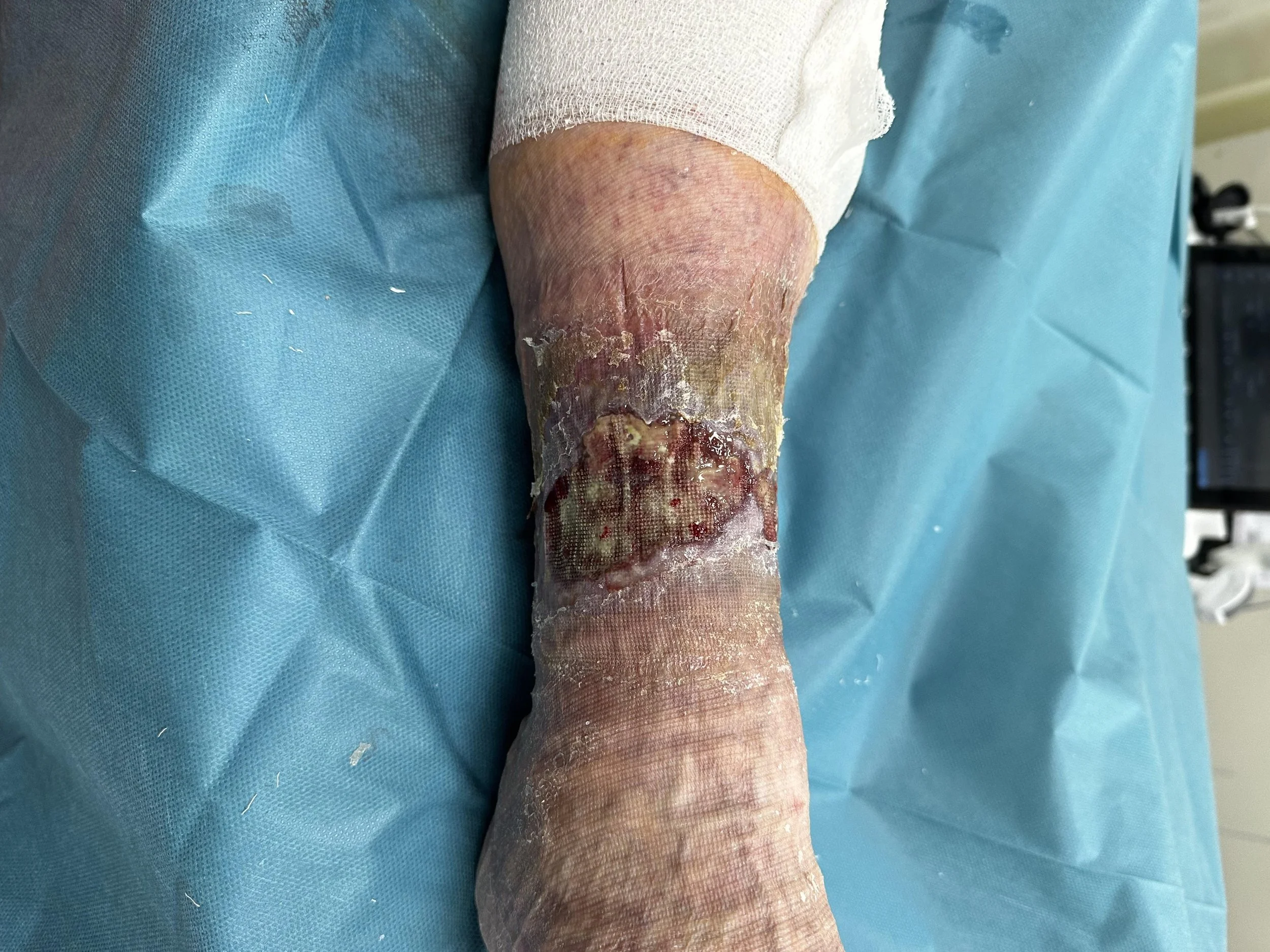 Severe circumferential ulceration