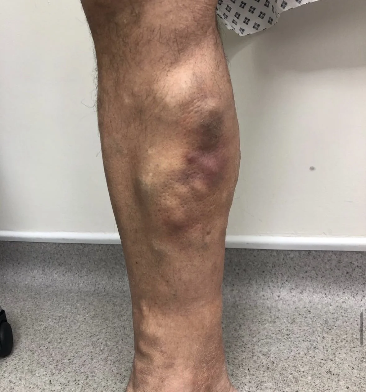 Phlebitis in vein inner calf, hard and red