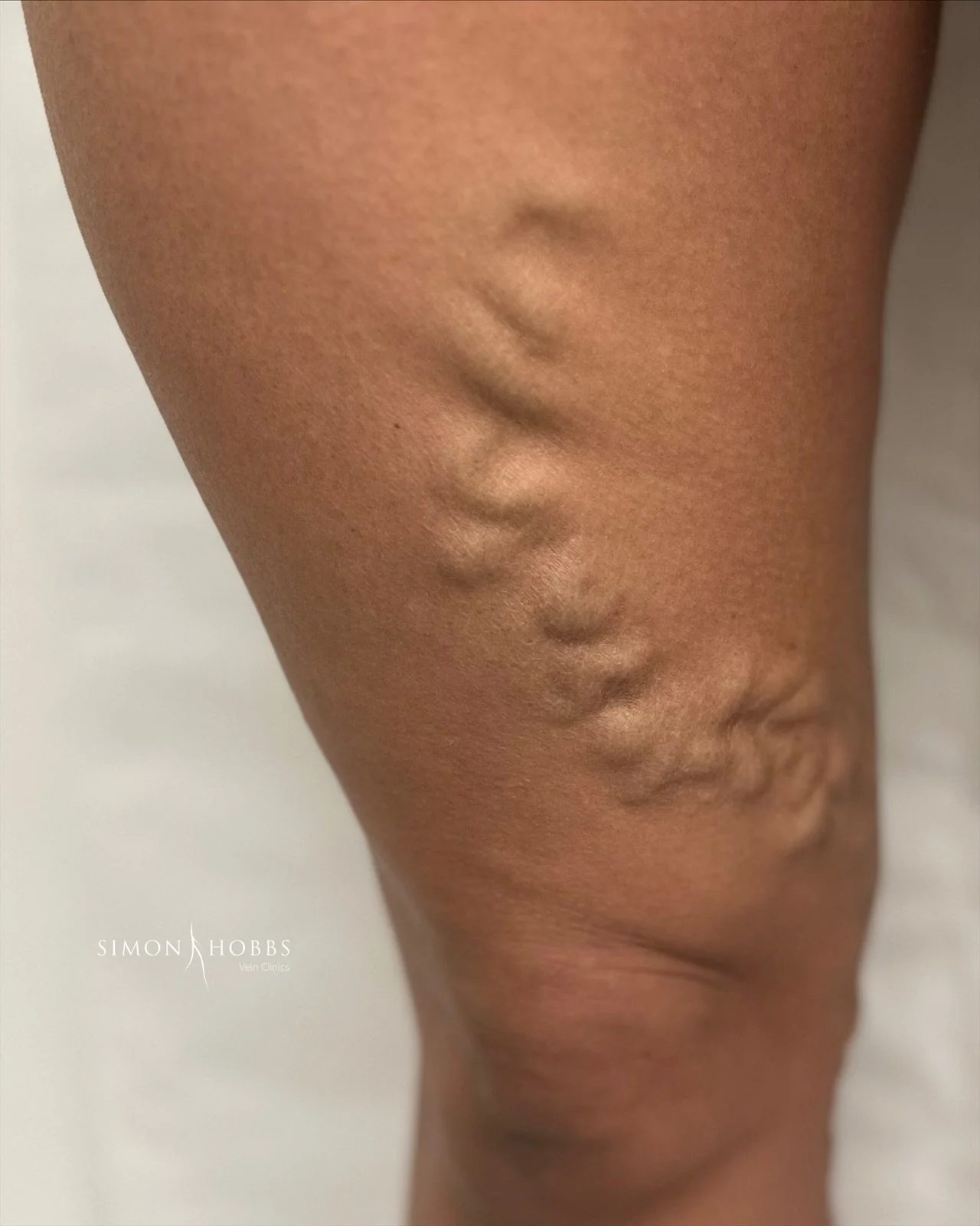 Varicose veins in the inner thigh