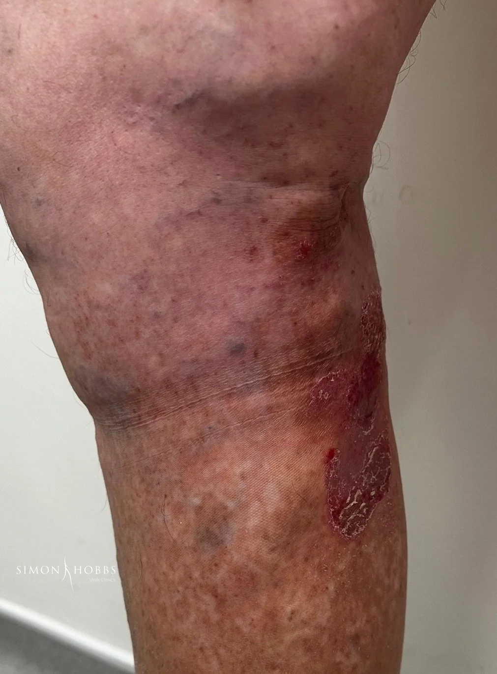Thread veins around the knee