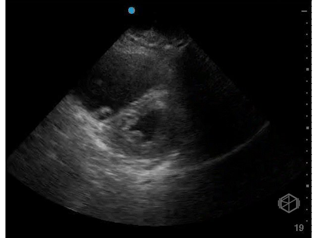 RV pressure overload — note how the LV never really turns back to a circular shape (pulmonary embolism).