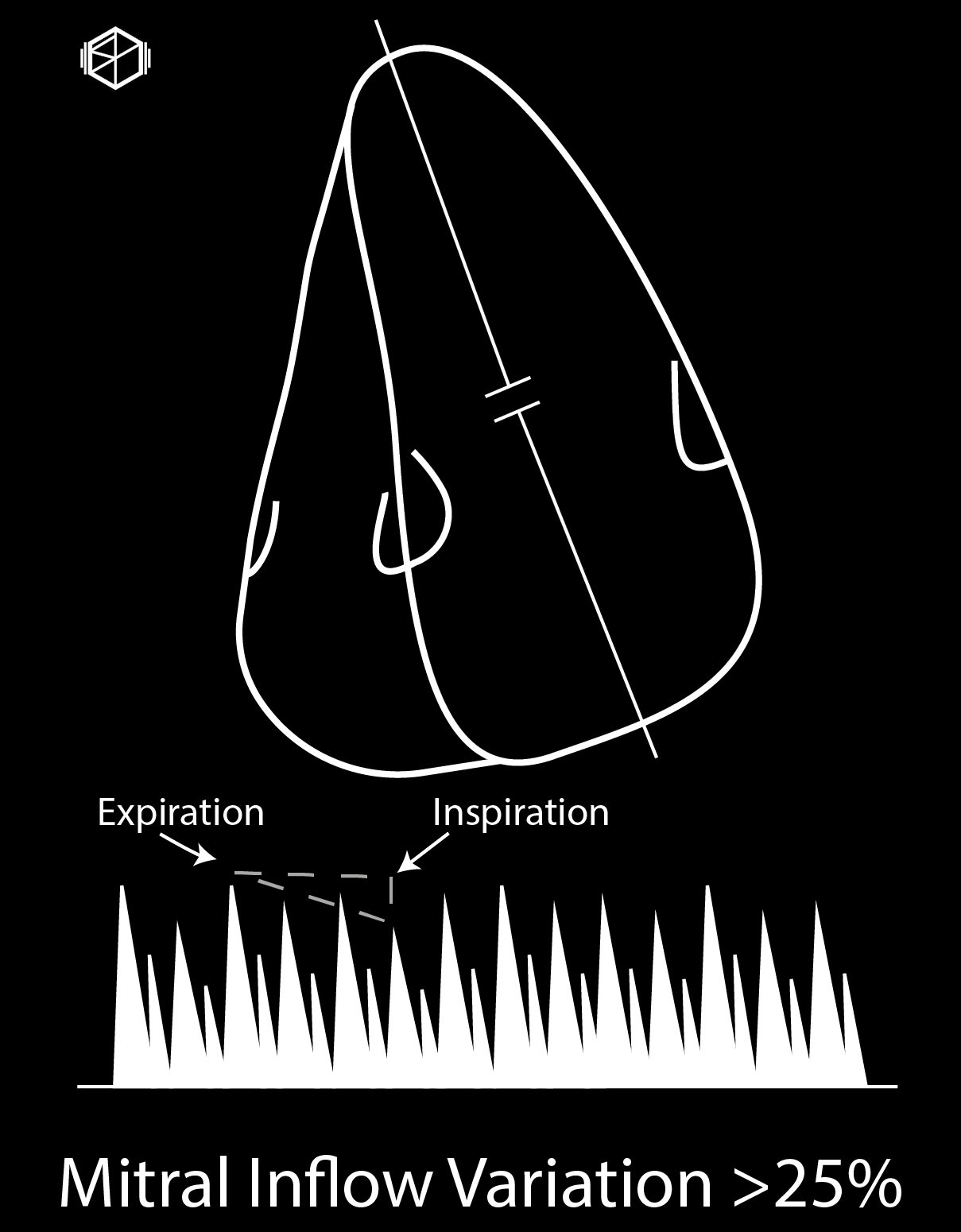 TamponadeHeartMitralInflowVariation-01_10.png