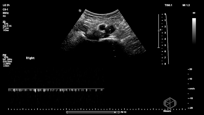 Loss of normal phasicity on pulse-wave doppler.