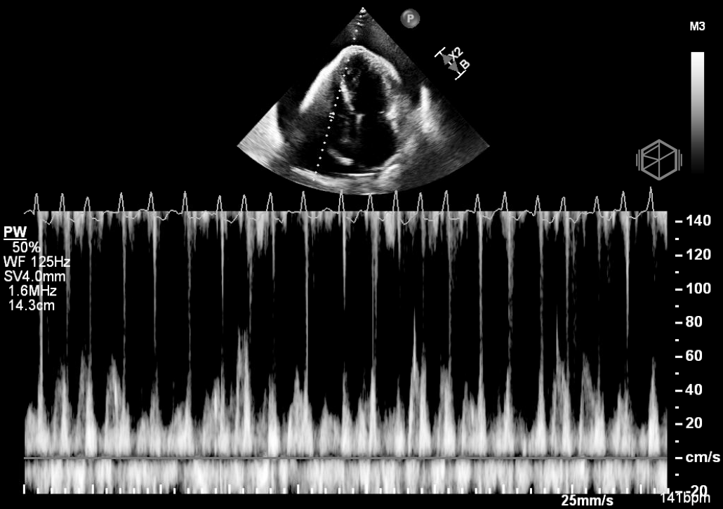 Significant tricuspid inflow variation >40%