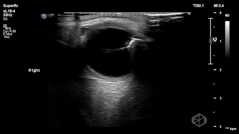 Hyperechoic linear structure penetrating the globe, concerning for a retained metallic intraocular foreign body. This bedside finding prompted immediate ophthalmology consultation, initiation of antibiotics, and urgent transfer for surgical managemen