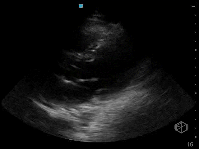 Normal LVEF (~55%)