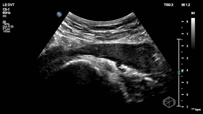 Long view of iliac vein DVT, echogenic material visible showing thrombus.