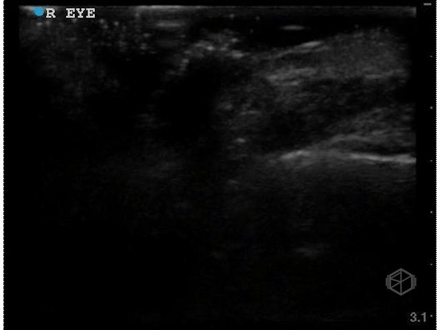 B-mode Ocular RD TV Dark