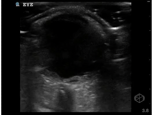 B-Mode Ocular TV Sagittal Dark