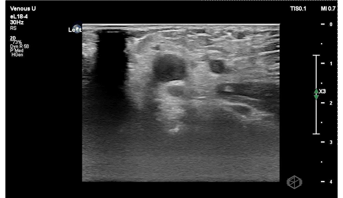 Subclavian vein with thrombus visible