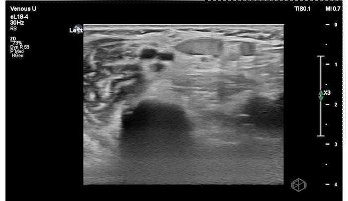 Visible echogenic thrombus within a brachial vein and the cephalic vein.