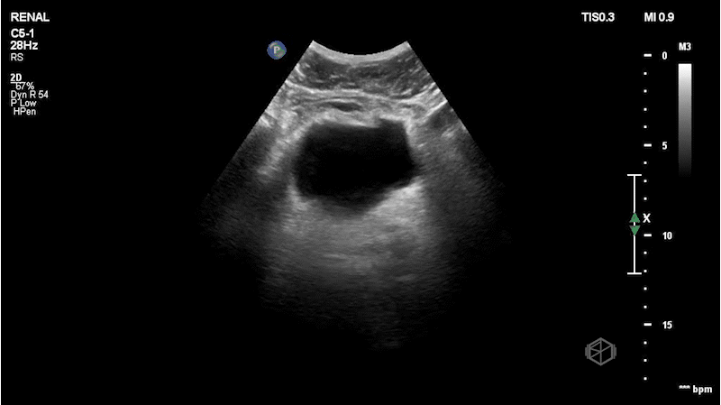 No hyperechoic stone bladder