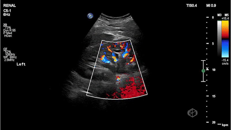 Moderate LEFT hydroureteronephrosis color doppler