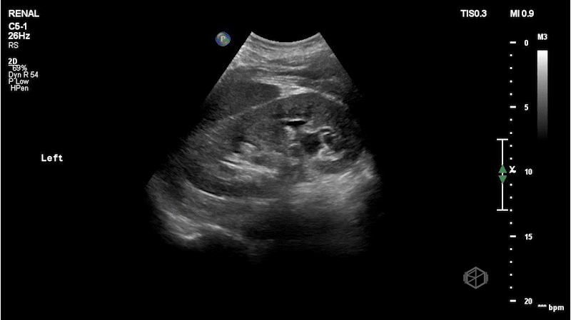 Moderate LEFT hydroureteronephrosis